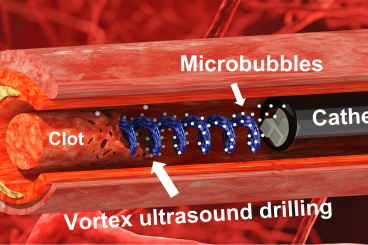 New Tool Uses Ultrasound ‘Tornado’ to Break Down Blood Clots